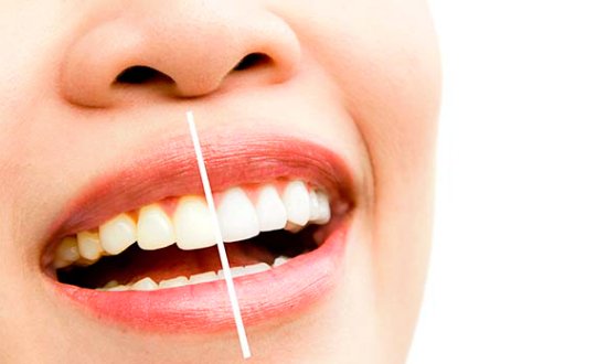Clareamento Dental