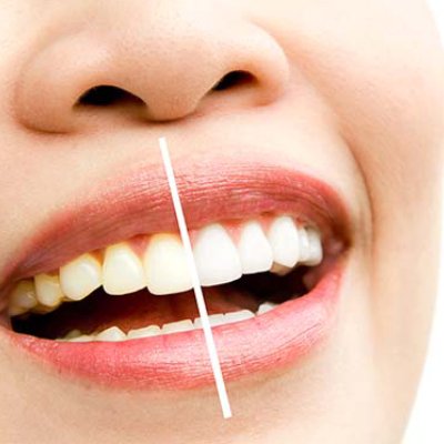 Clareamento Dental